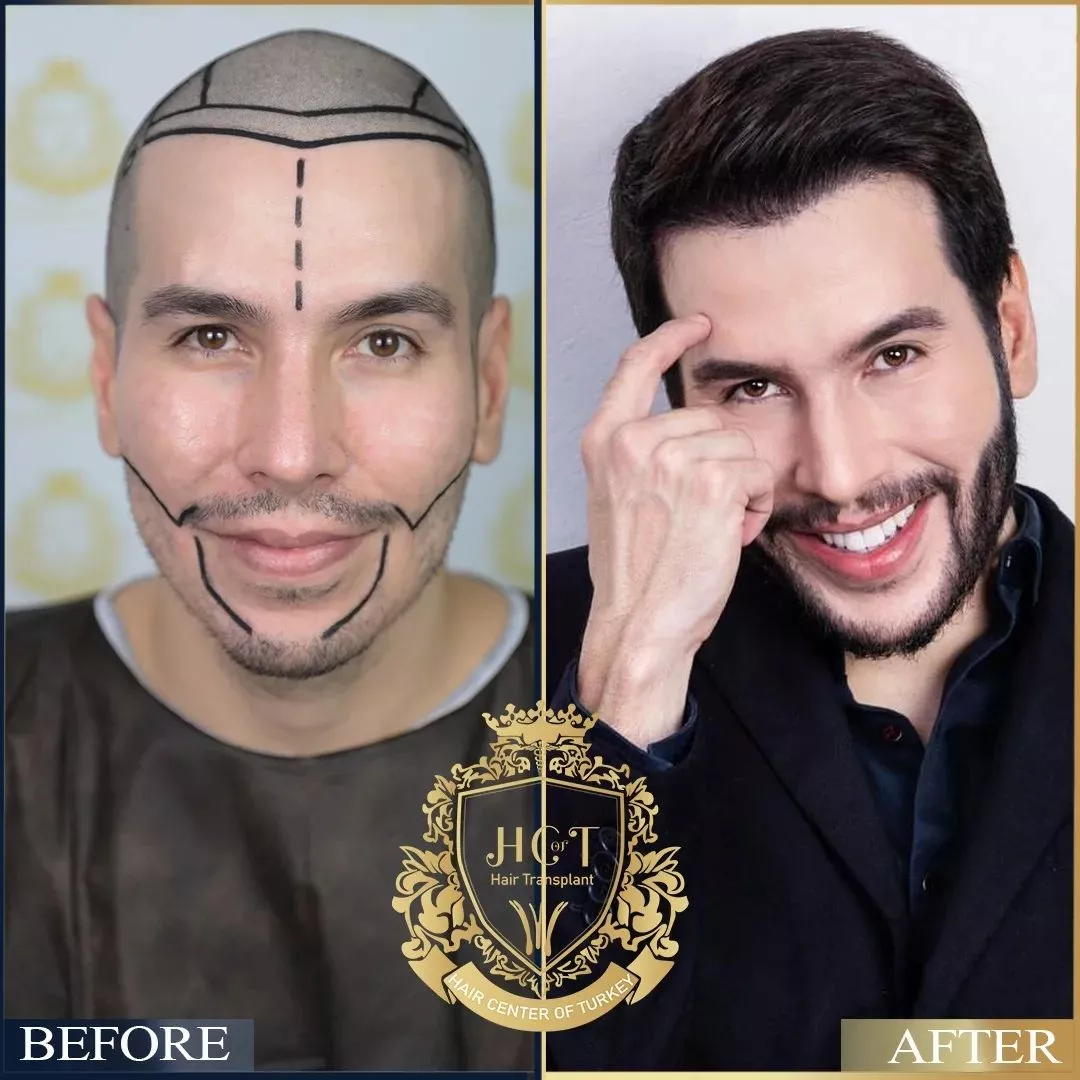 eyebrow transplant eyebrow transplant
