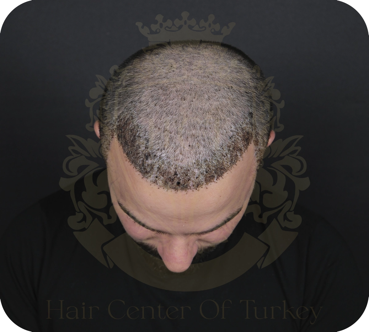 What Causes Crusting After Hair Transplant?