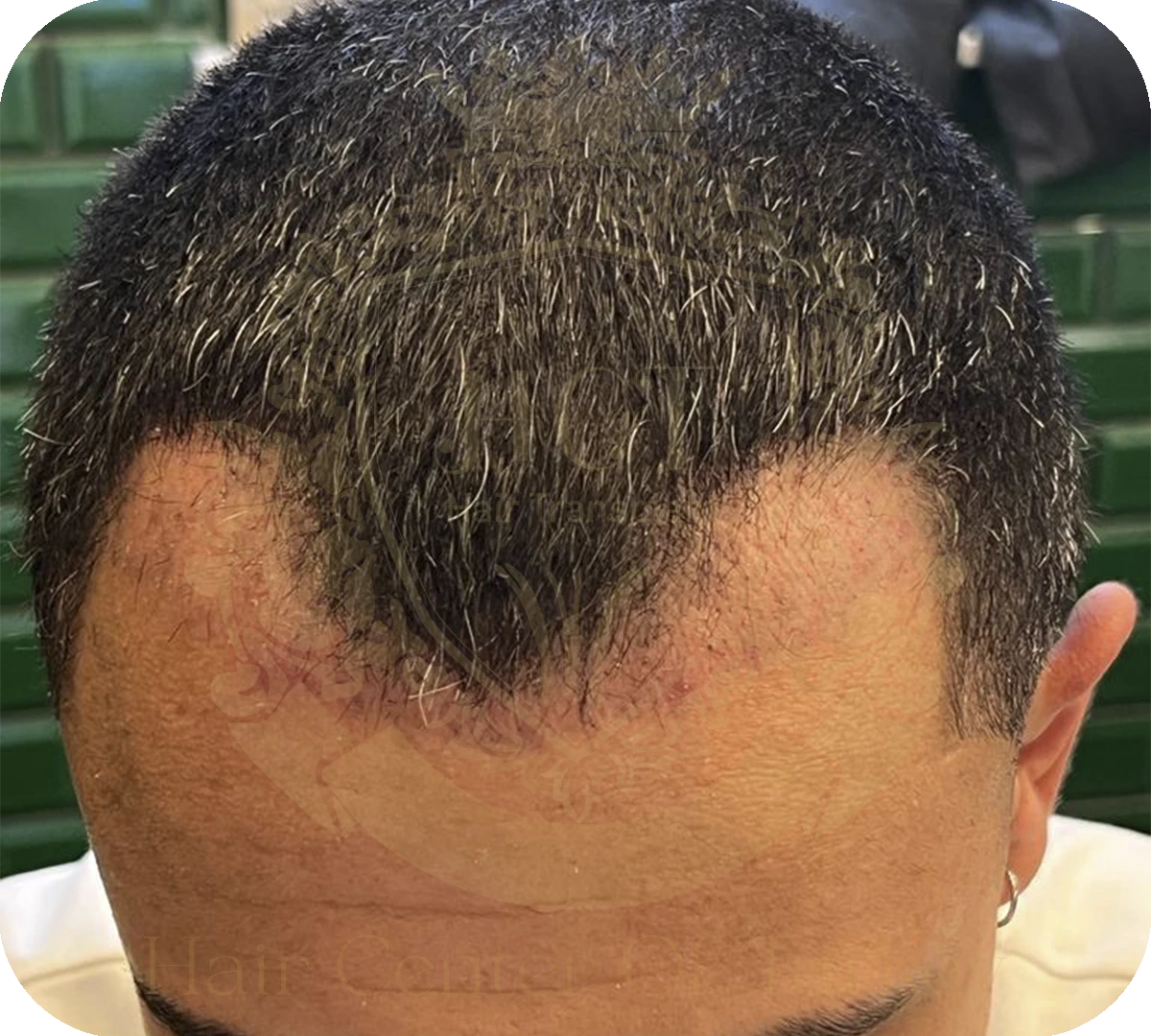 Shock Loss After Hair Transplant